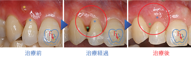 歯周組織再生療法・根面被覆術